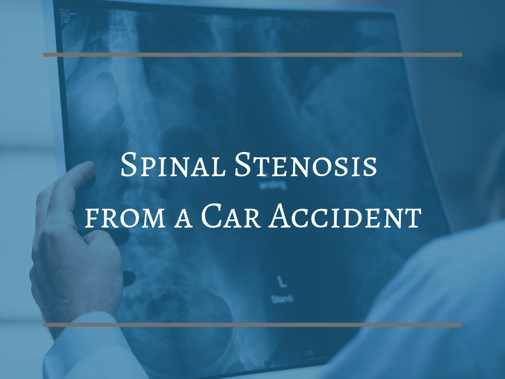 Spinal Stenosis from a Car Accident